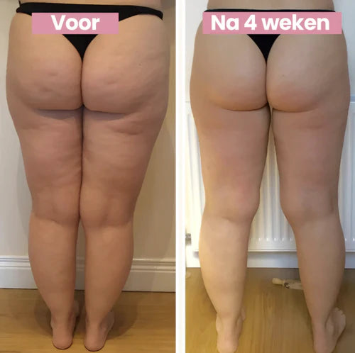 CelluFit Therapie Pro | #1 Anti-Cellulitis Apparaat Met EMS, Cupping & Rood Licht