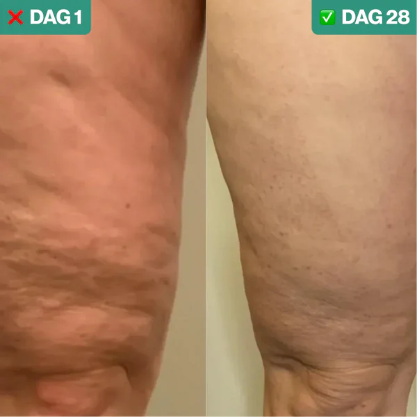 CelluFit Therapie Pro | #1 Anti-Cellulitis Apparaat Met EMS, Cupping & Rood Licht