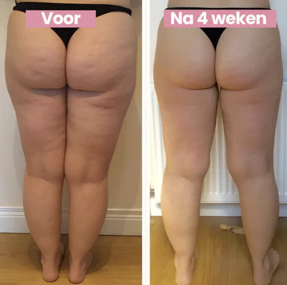 CelluFit Therapie Pro | #1 Anti-Cellulitis Apparaat Met EMS, Cupping & Rood Licht